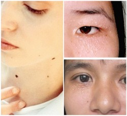 Đốt nốt ruồi, mụn thịt, mụn cóc ( tùy nốt )