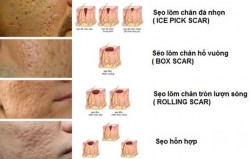 Điều trị các loại sẹo ( lồi, lõm )