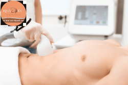 Triệt lông vùng bụng