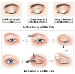 Cắt da thừa mí trên