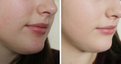 Điều trị dày da