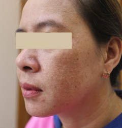 Peel Nám trọn gói