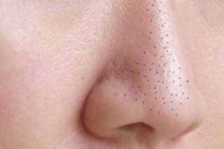 Điều trị mụn cám căn bản