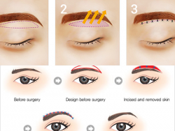 Treo chân mày, nâng cơ