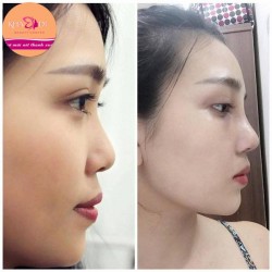 Nâng mũi sline HQ sóng mềm