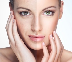 Điều trị sắc tố da Nám, tàn nhang, đồi mồi, rối loạn sắc tố