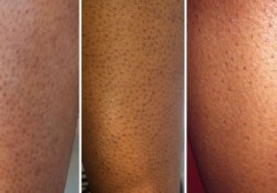 Điều Trị viêm nan lông ( nách, lưng, bụng, ngực, mông, ½ tay, ½ chân )