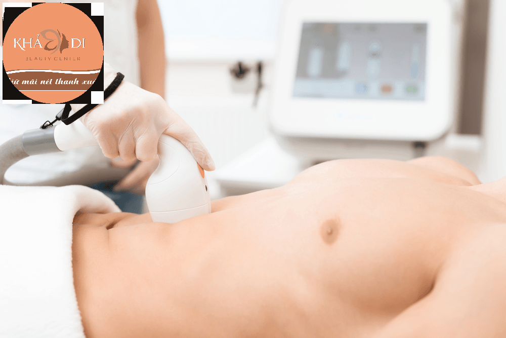 Triệt lông vùng bụng