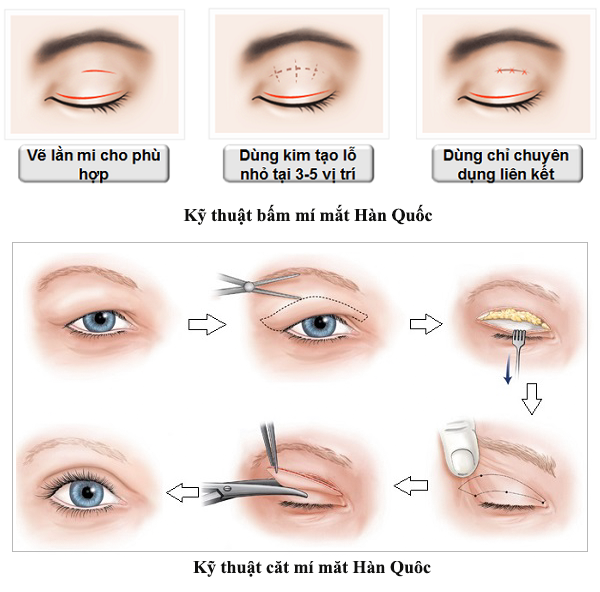 Cắt da thừa mí trên