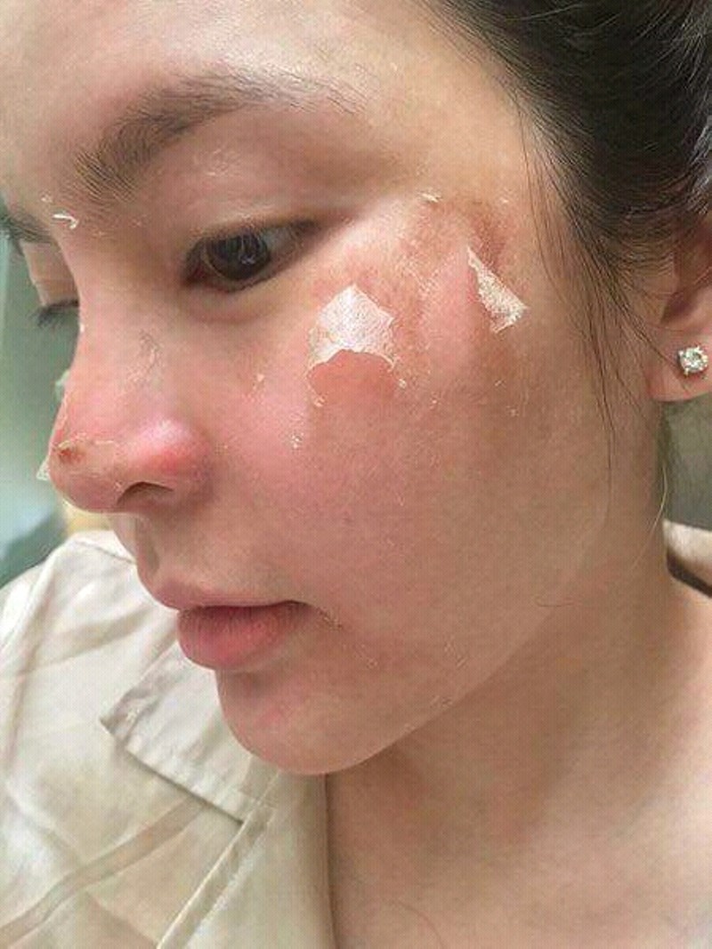 Peel da rỗ trọn gói