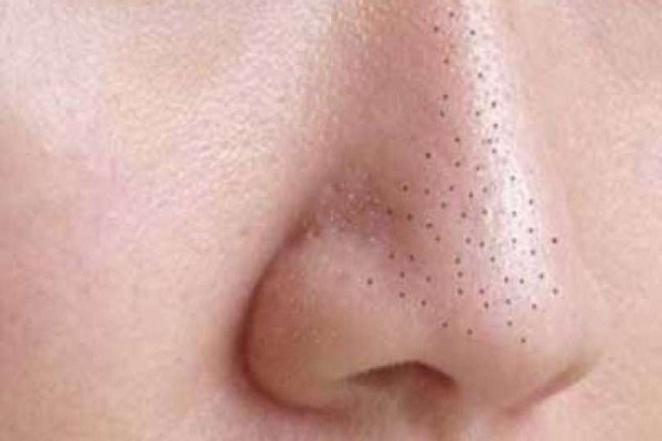 Điều trị mụn cám căn bản