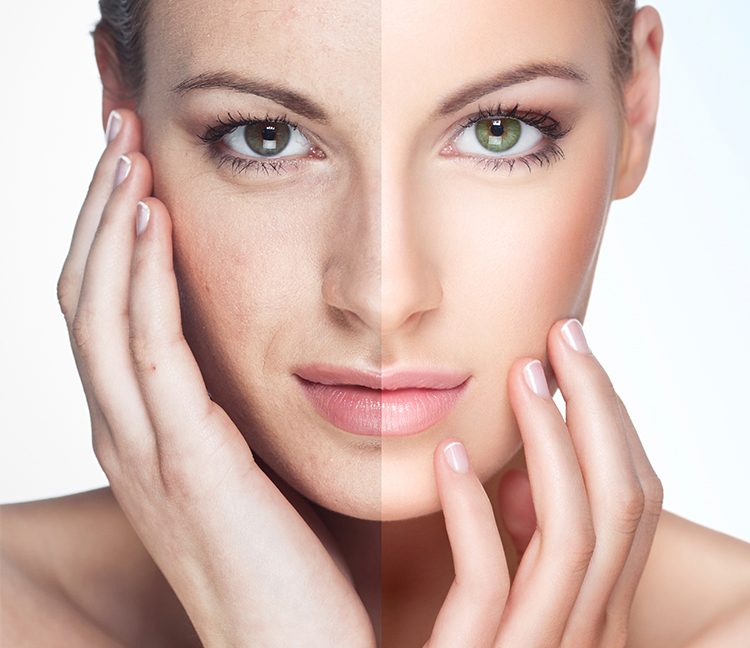 Điều trị sắc tố da Nám, tàn nhang, đồi mồi, rối loạn sắc tố