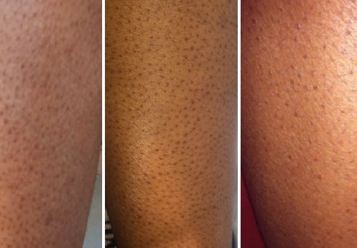 Điều Trị viêm nan lông ( nách, lưng, bụng, ngực, mông, ½ tay, ½ chân )